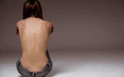 ¿Qué es la anorexia nerviosa?